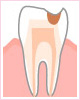 C2：象牙質の虫歯