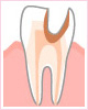 C3：歯の神経の虫歯