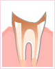 C4：歯根の虫歯