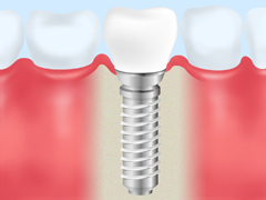 インプラント治療 