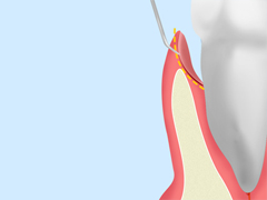 歯周ポケット掻爬術
