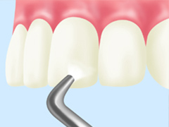 PMTC（プロによる歯のクリーニング）